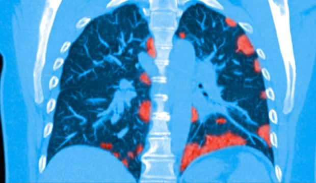 Dünyada ilk: Koronavirüsten ölen kişinin ciğerleri görüntülendi