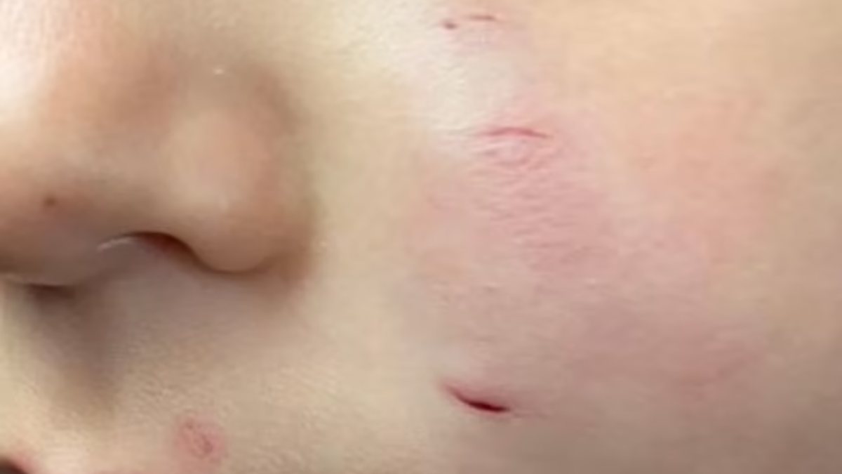 İngiltere’de 2 yaşındaki çocuğun yüzünü fare ısırdı